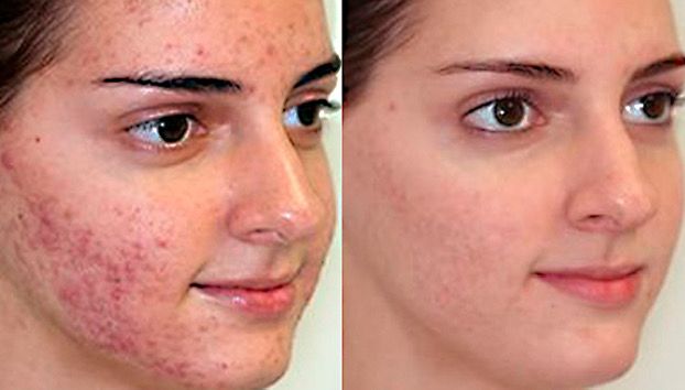 Acne Treatment