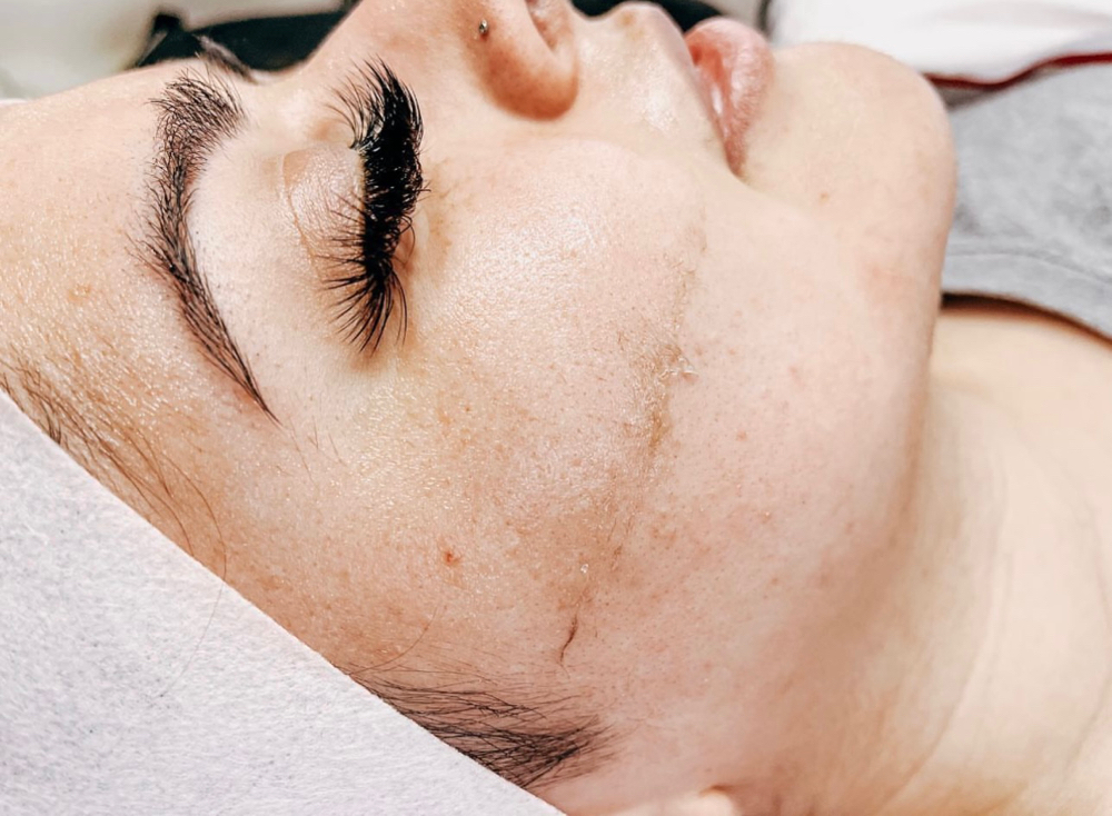 Dermaplaning