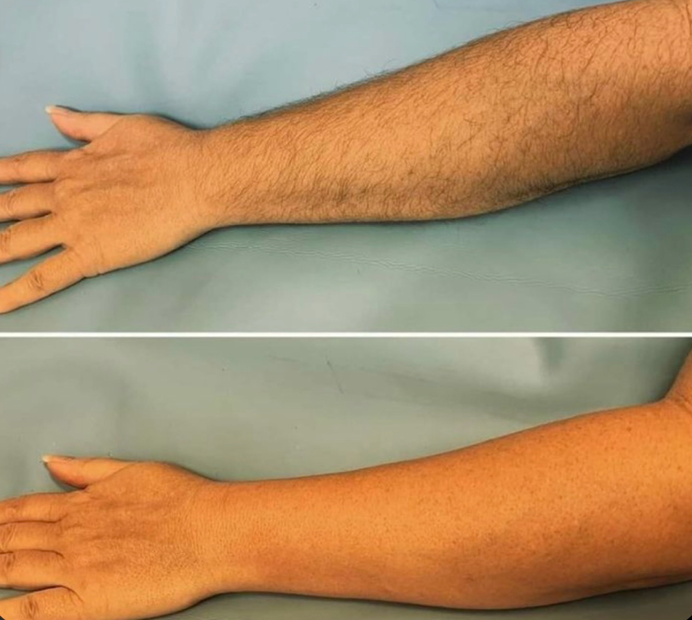 Arm Wax