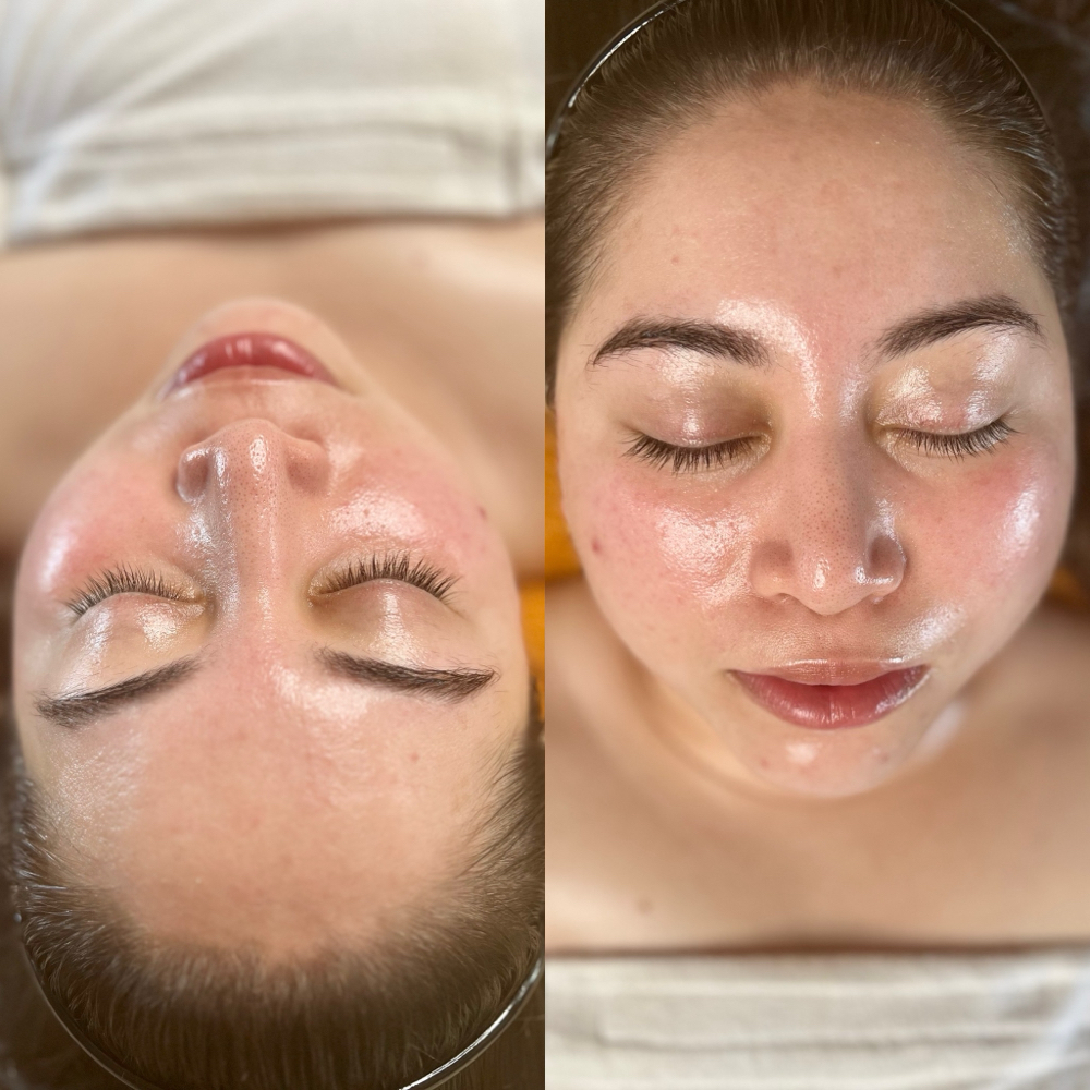Hydrodermabrasion Face, Neck & Déco