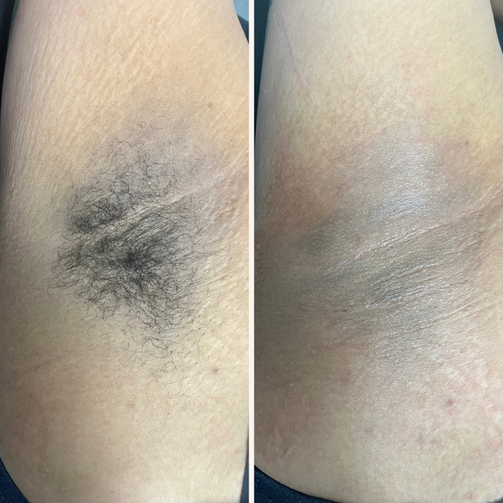 Underarm Wax