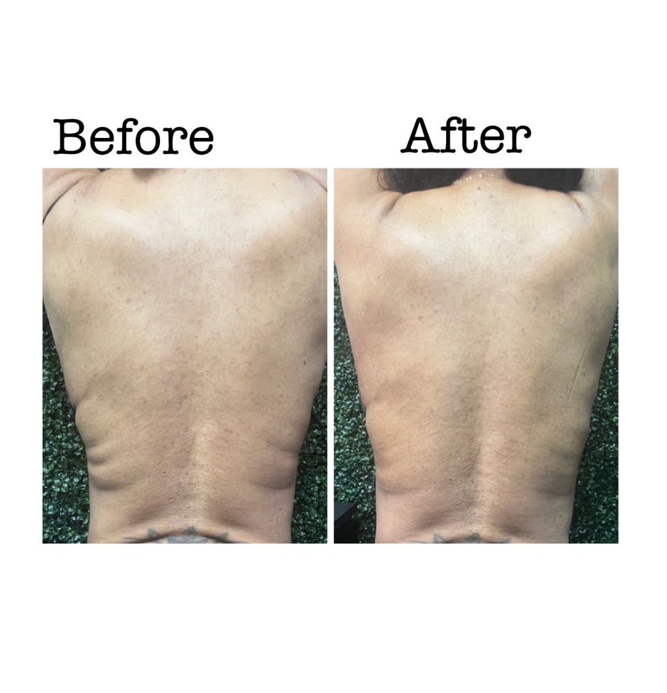 RF/Cavitation/laser Lipo at Wholistic Recovery & Wellness Spa in Snellville, GA