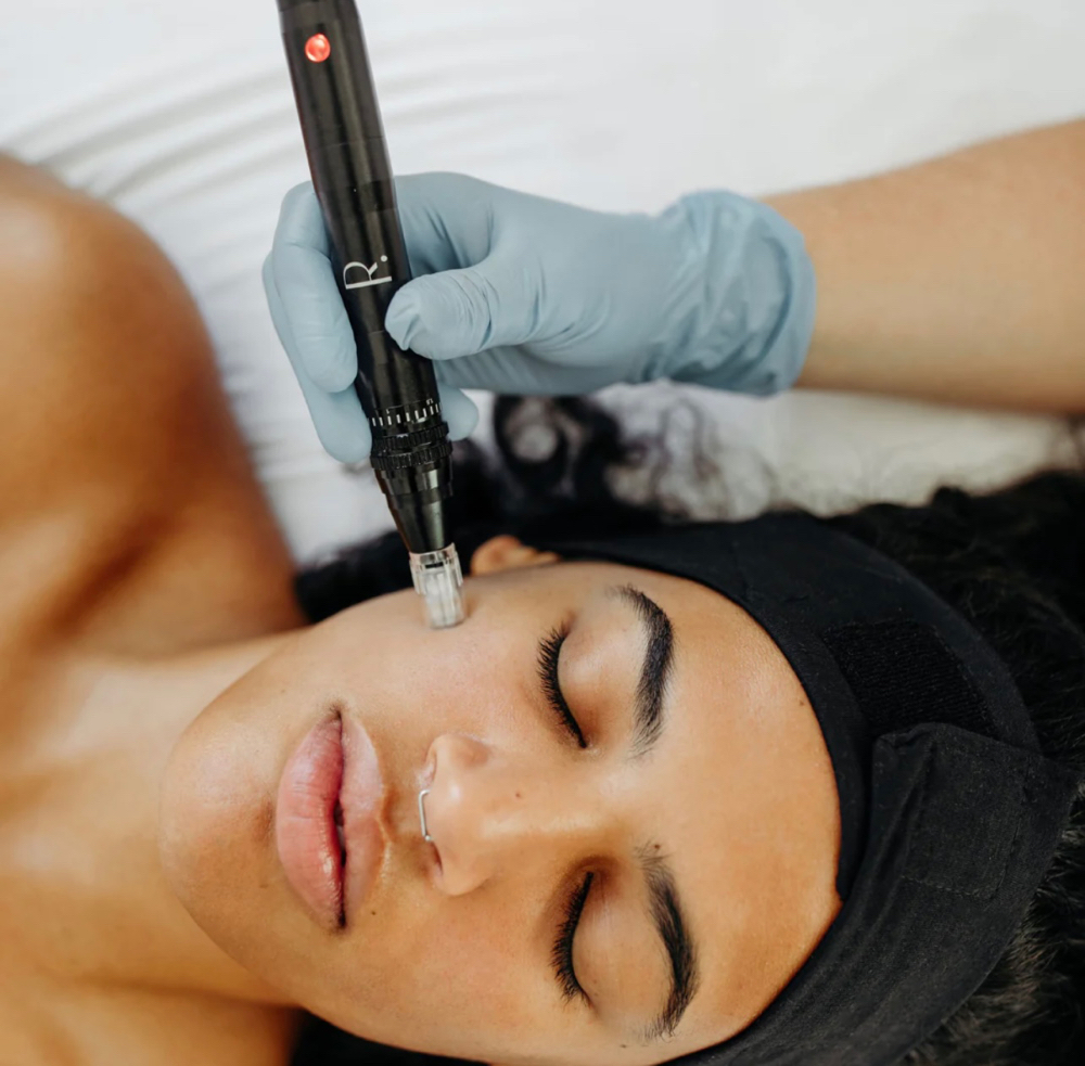 Collagen Induction MicroNeedling