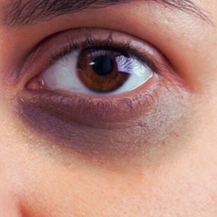 Under Eye Treatment at Luxe Royale Spa in Paramus, NJ