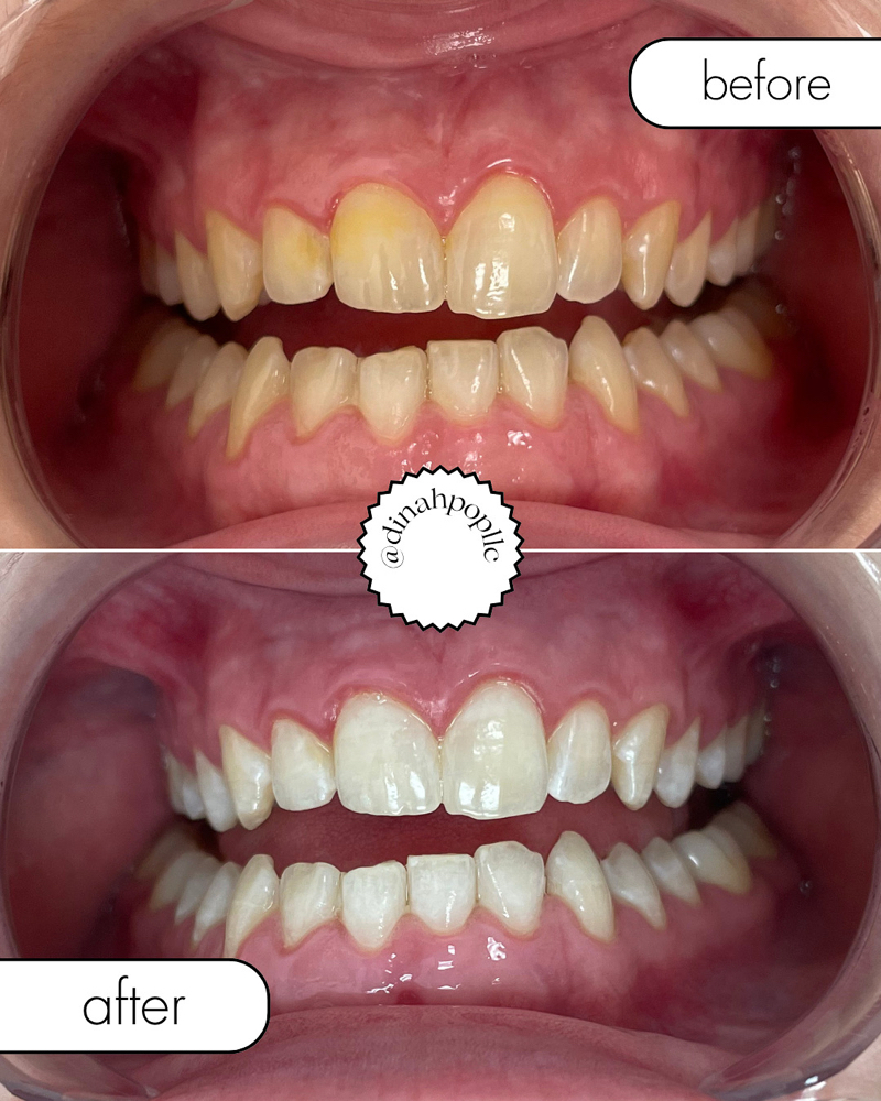 Teeth Whitening PROMO 🦷