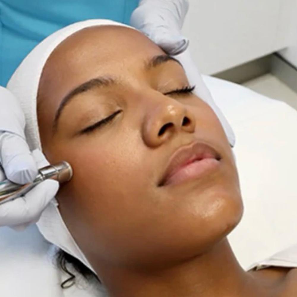 Microdermabrasion at KDM Derma Therapy in Centerton, AR