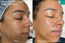 Chemical Peel (Advance)
