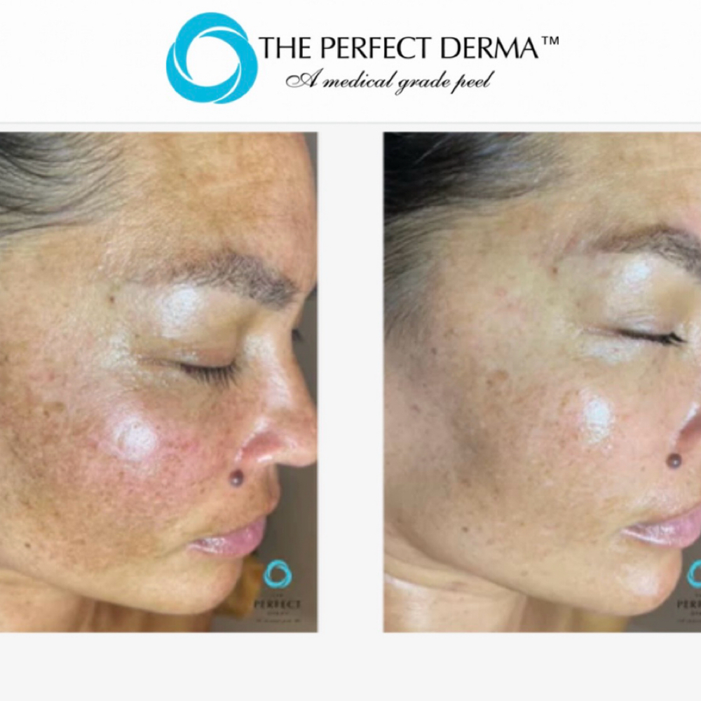Chemical Peel (Advanced) at Rejuva Glow Beauty in Bethesda, MD