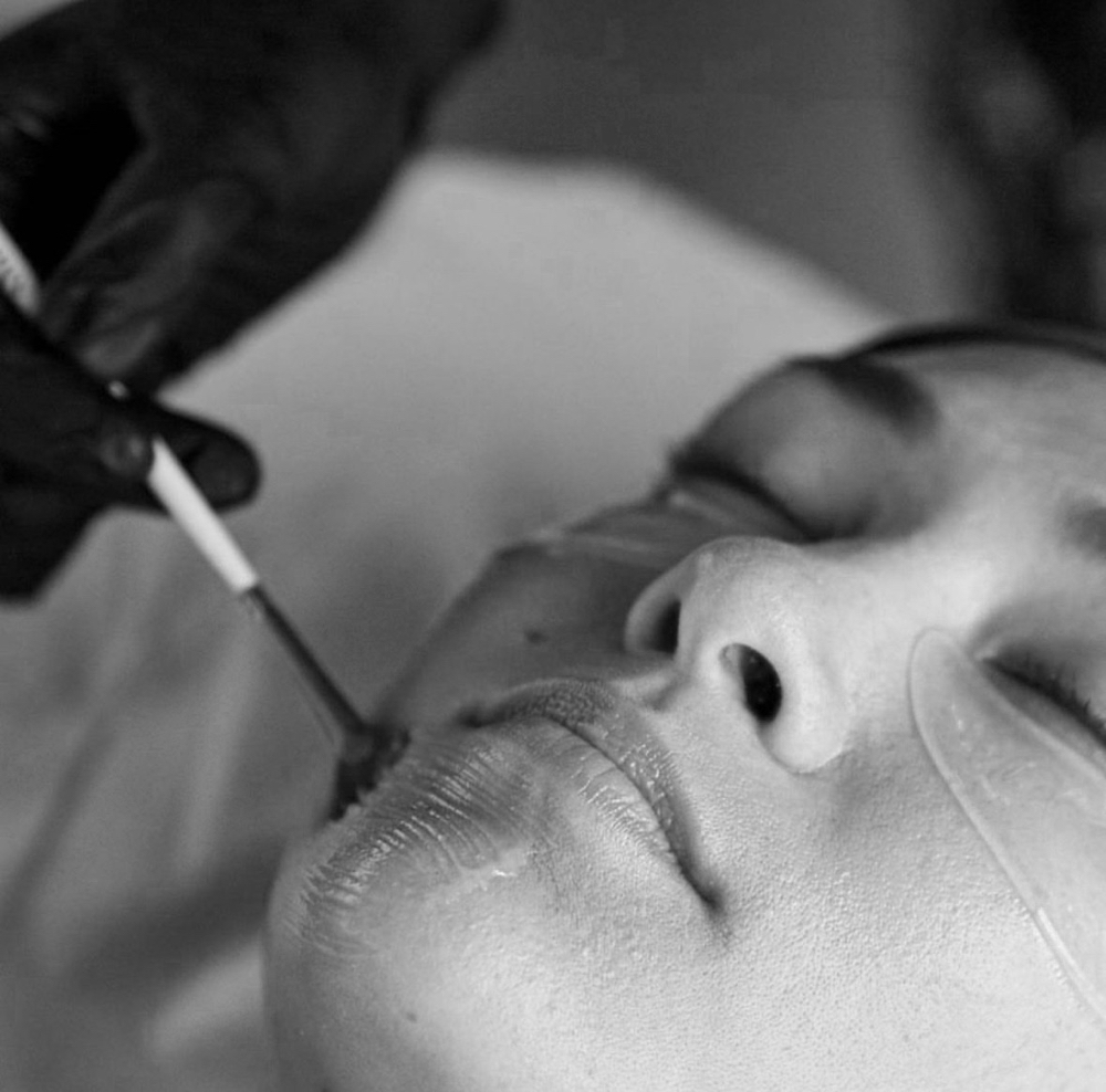 Acid Peel Facial