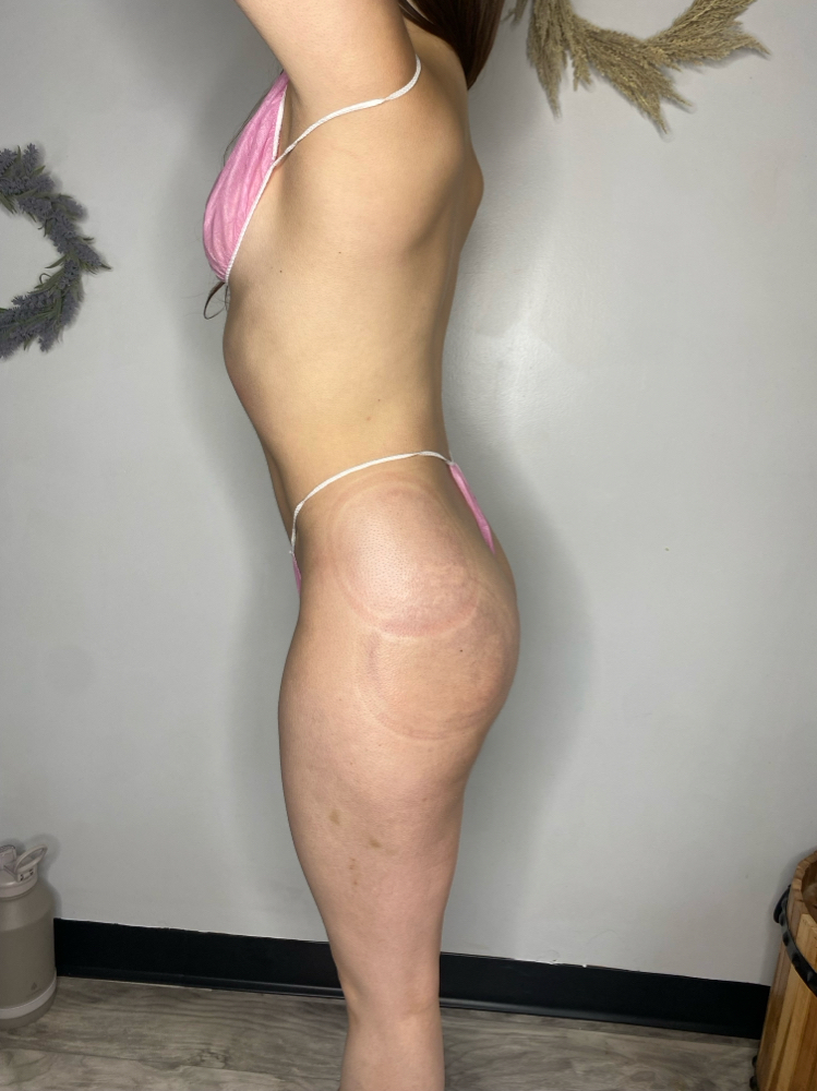 Post Op Maintenence at LuxBeautique in Pawtucket, RI