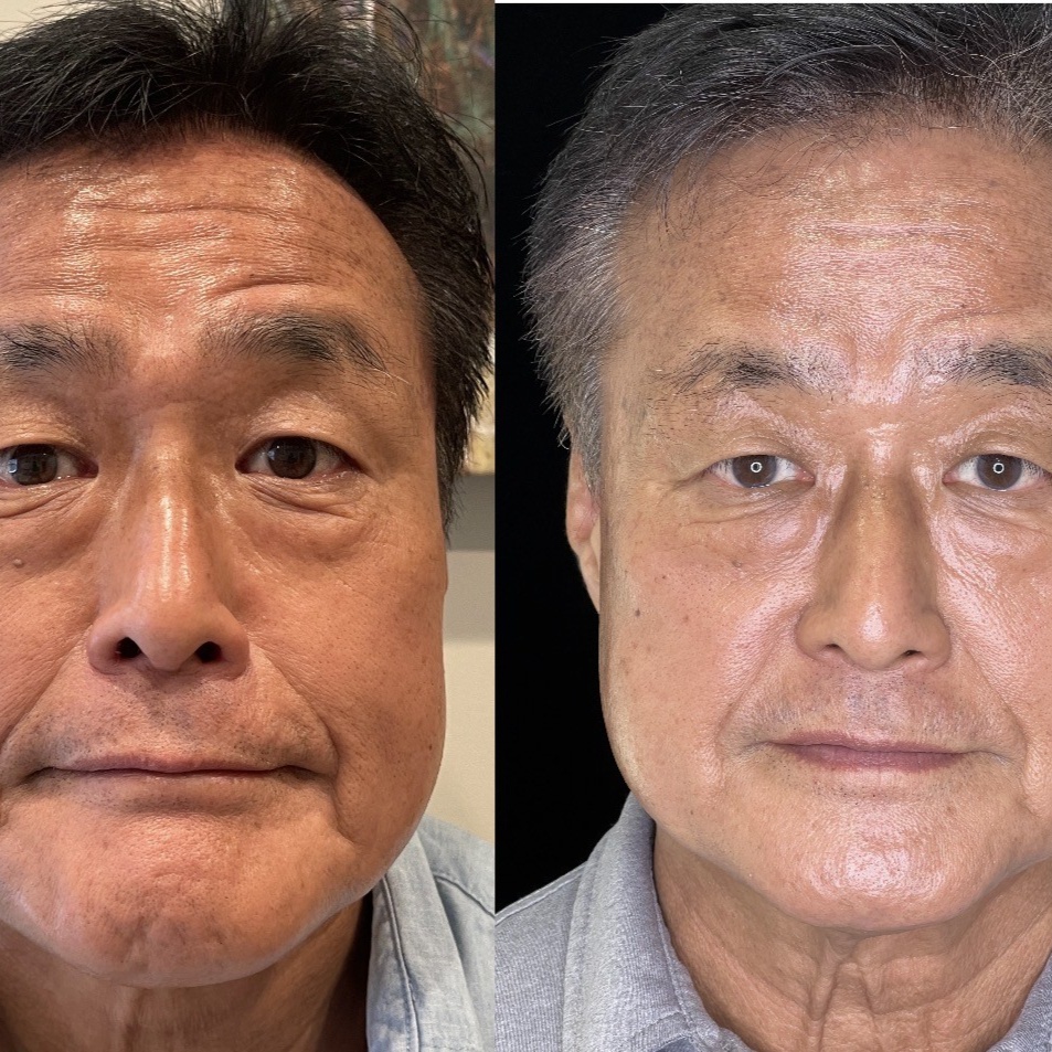 RF microneedling | Tightening at Corrective treatments + professional skincare in Atlanta, GA