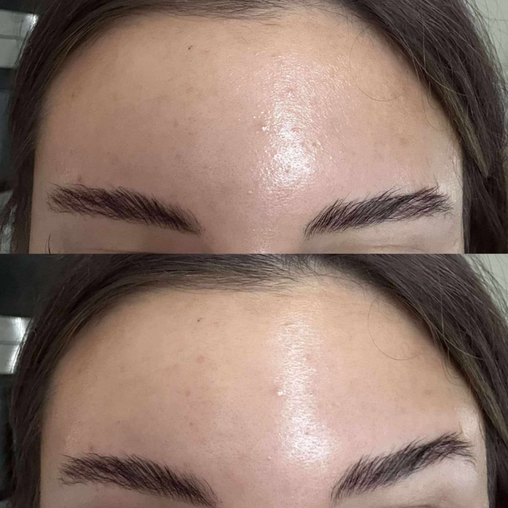 Forhead Tox