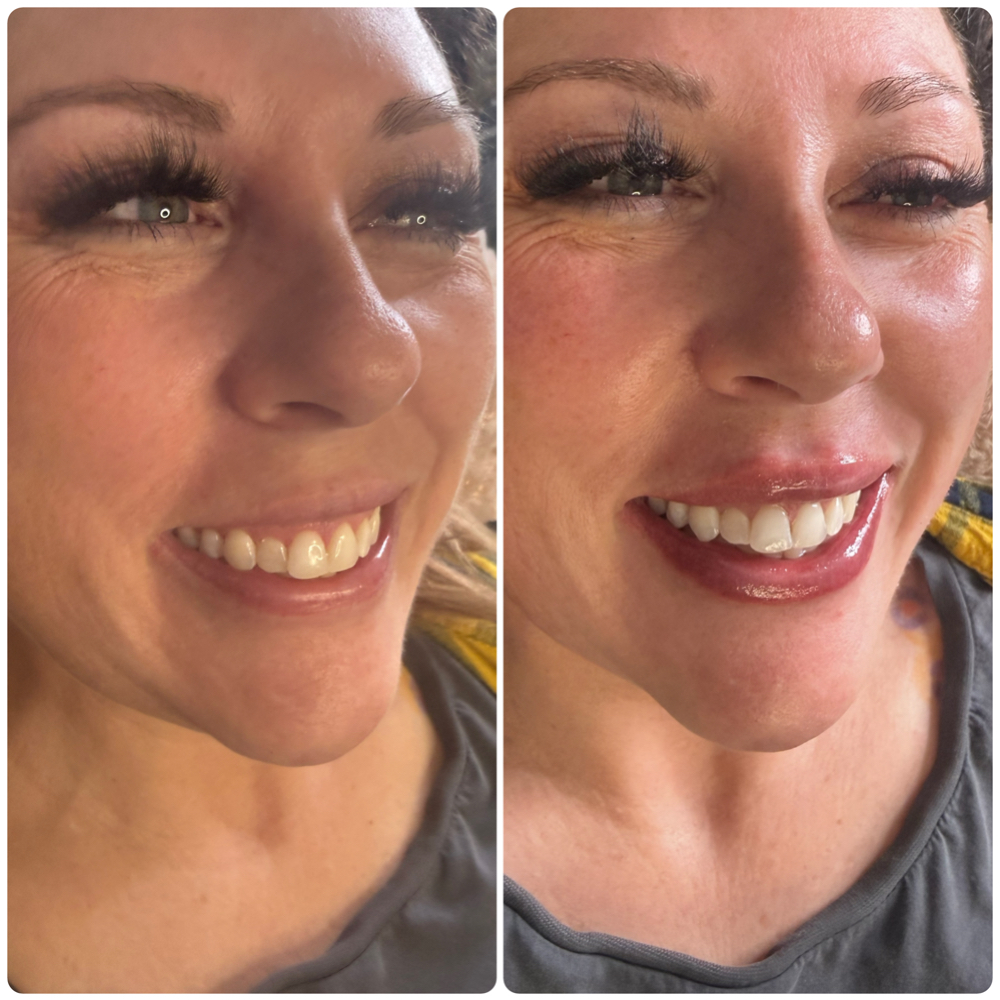 Facial + Teeth Whitening Bundle at Lavish Beauty Bar in Bennett, CO