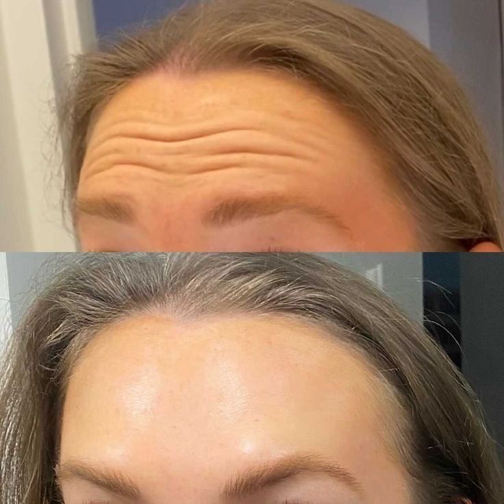 Forehead