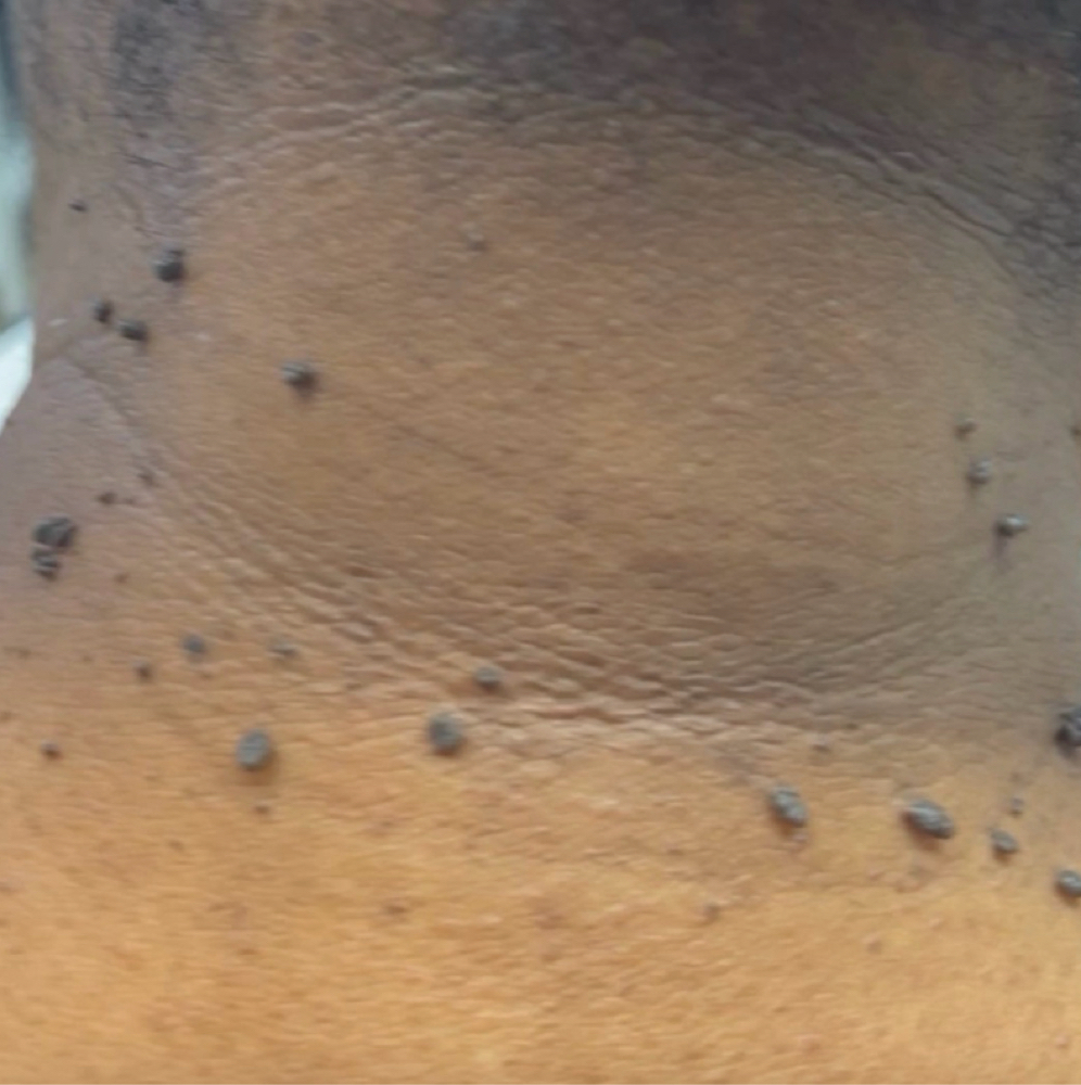 Skin Imperfection Neck at The Art of Glow by Chelle in New York, NY