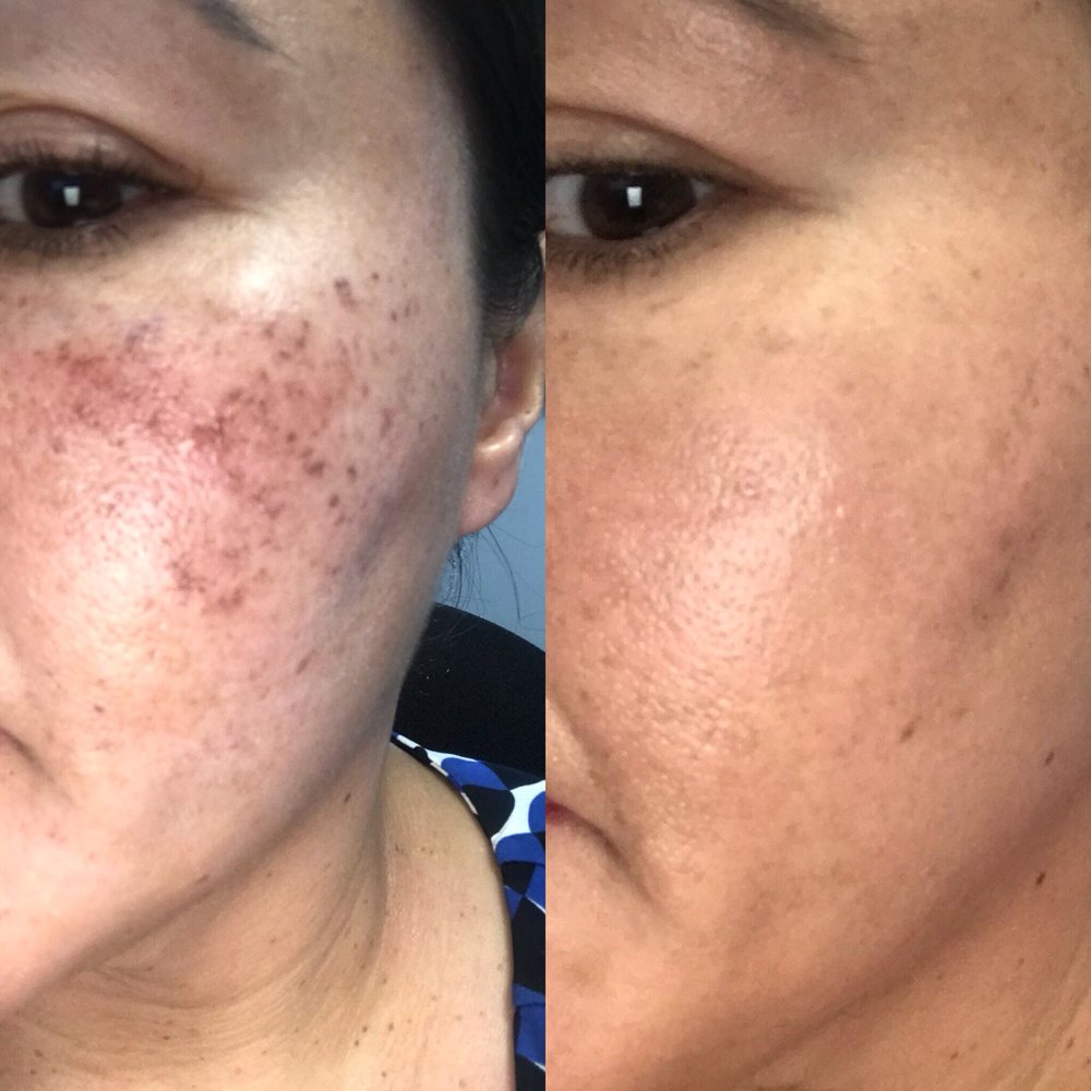 ACNE- MICRO NEEDLING THERAPY
