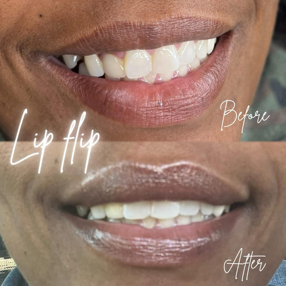 Tox-Single Lip Flip💉 at BeautyHolic Aesthetics LLC in Lubbock, TX