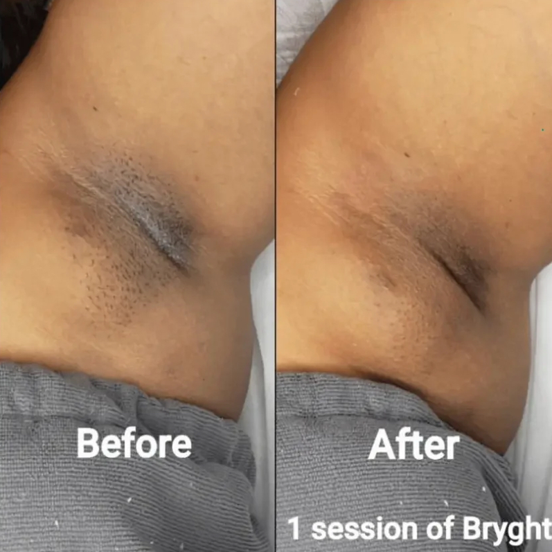 Intimate Bleaching- Underarms