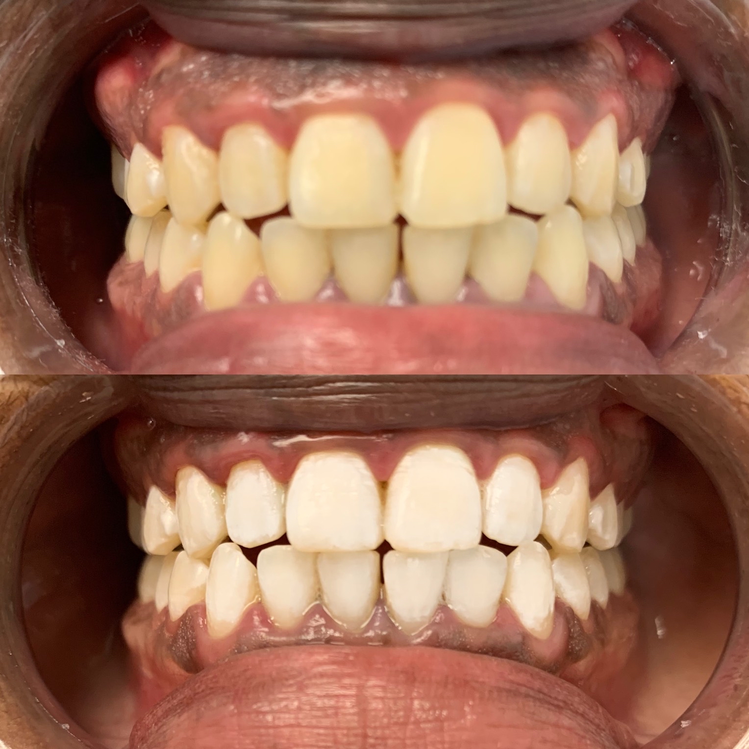 Cosmetic Teeth Whitening