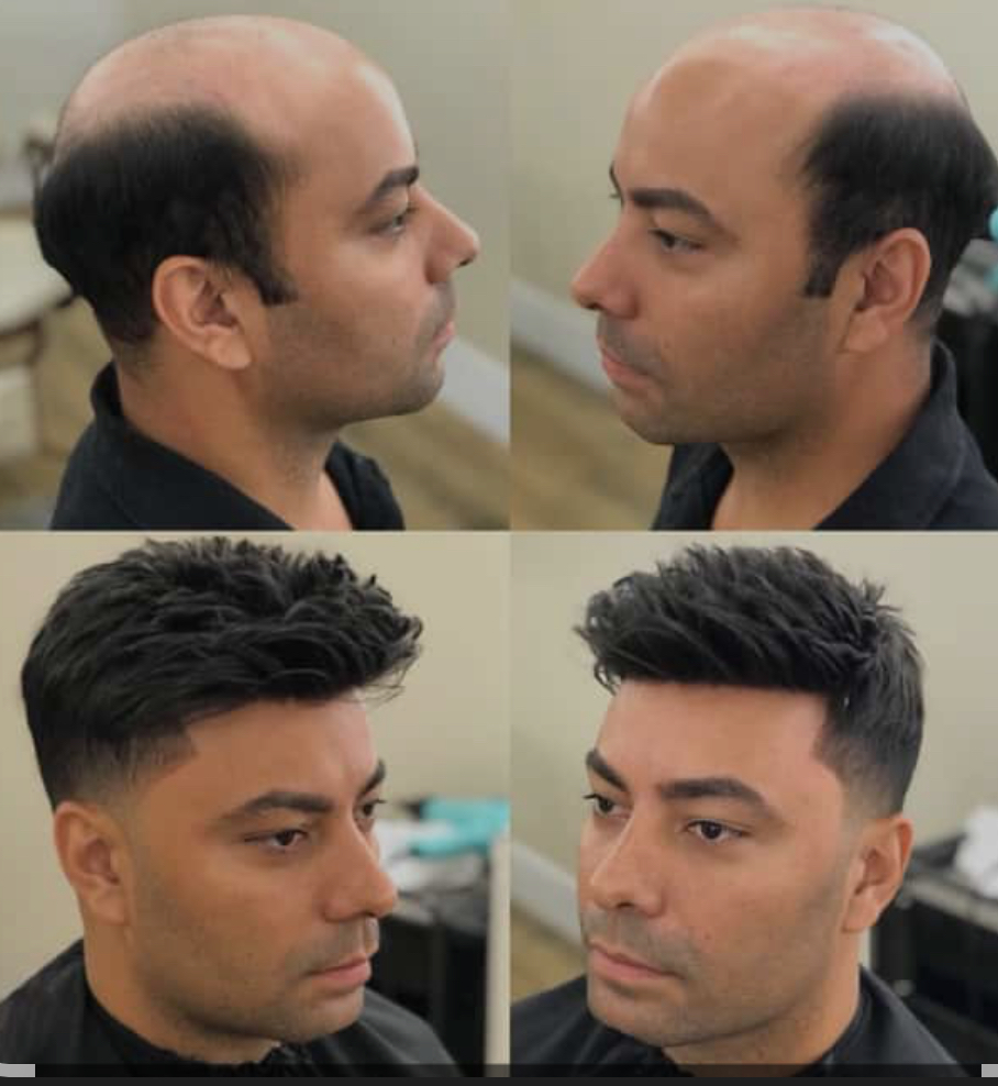 Hair Replacement (Consultation)