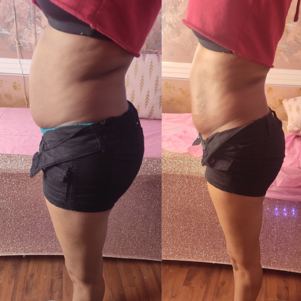 Lipo Injections ✨ 3 Sessions at Boujee Asthetics ✨ in Tucson, AZ