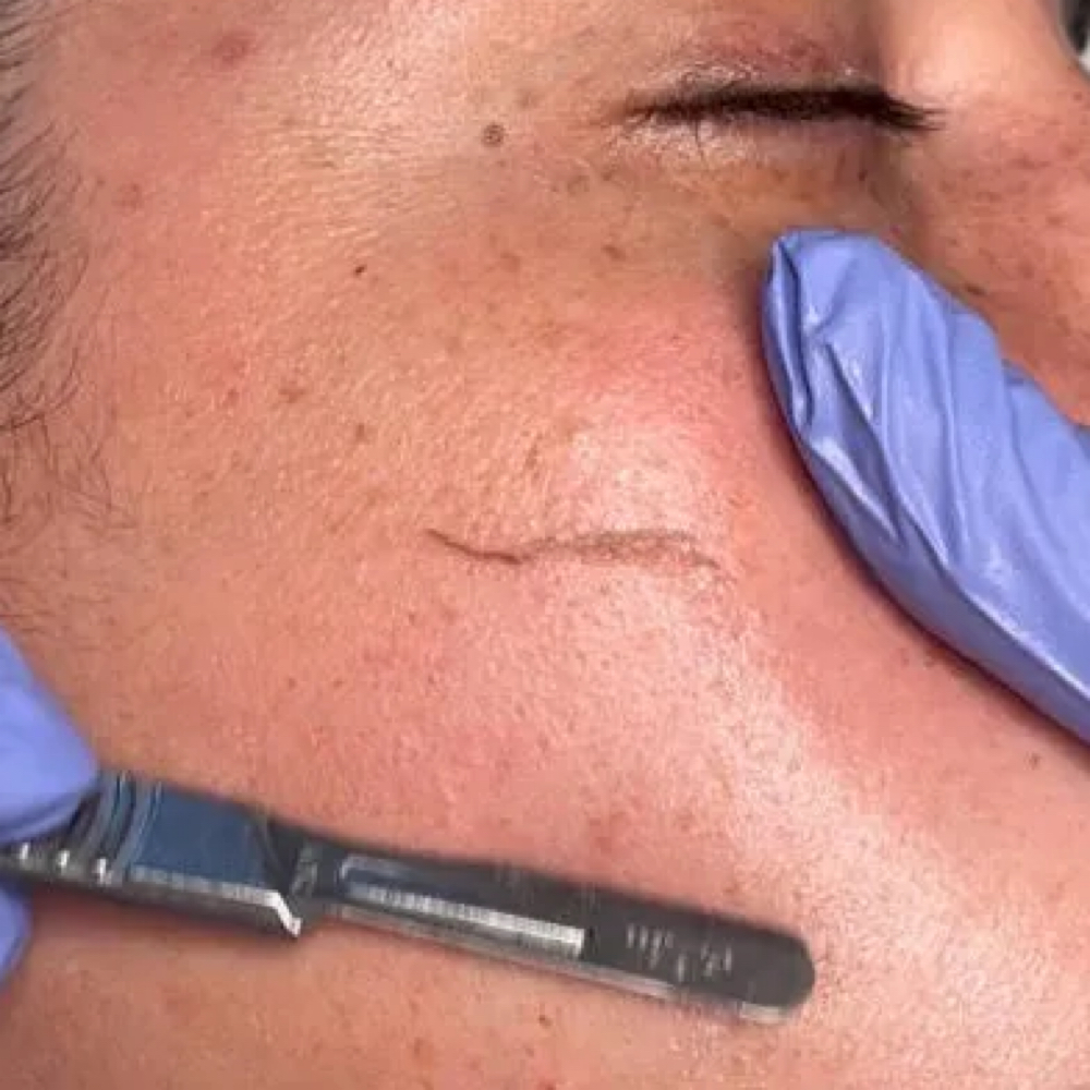 Dermaplane Add On Only at Glam by Tam Aesthetics in Madison, WI