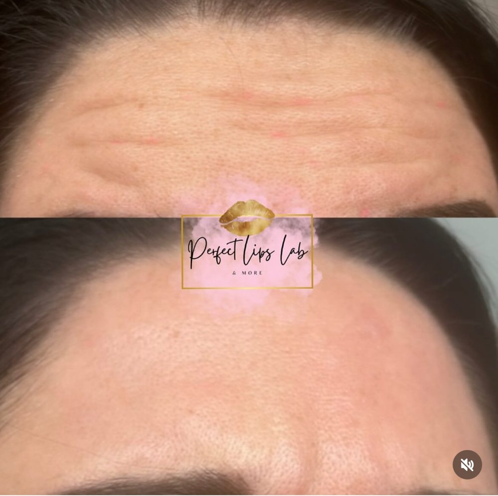 Botox 50 units