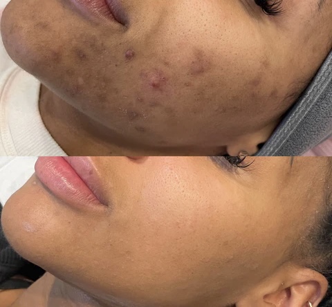 MicroNeedling