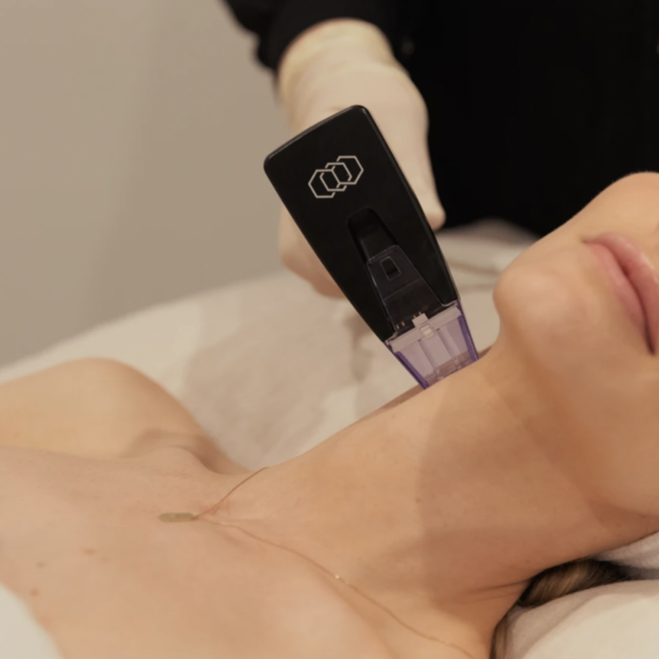 Morpheus8 - Face&Neck Microneedling