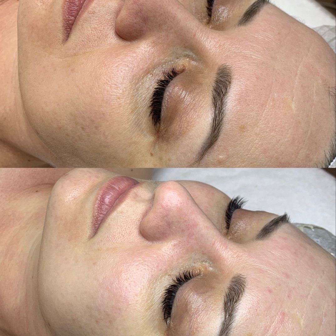 Signature Deep Cleansing Facial at Healthy skin by Alvina in Highland Park, IL