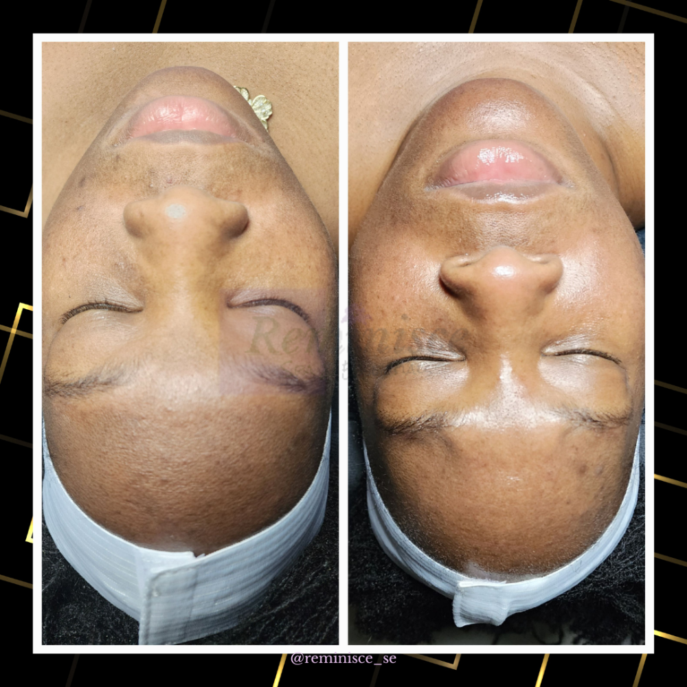 Refresher Facial/Microdermabrasion