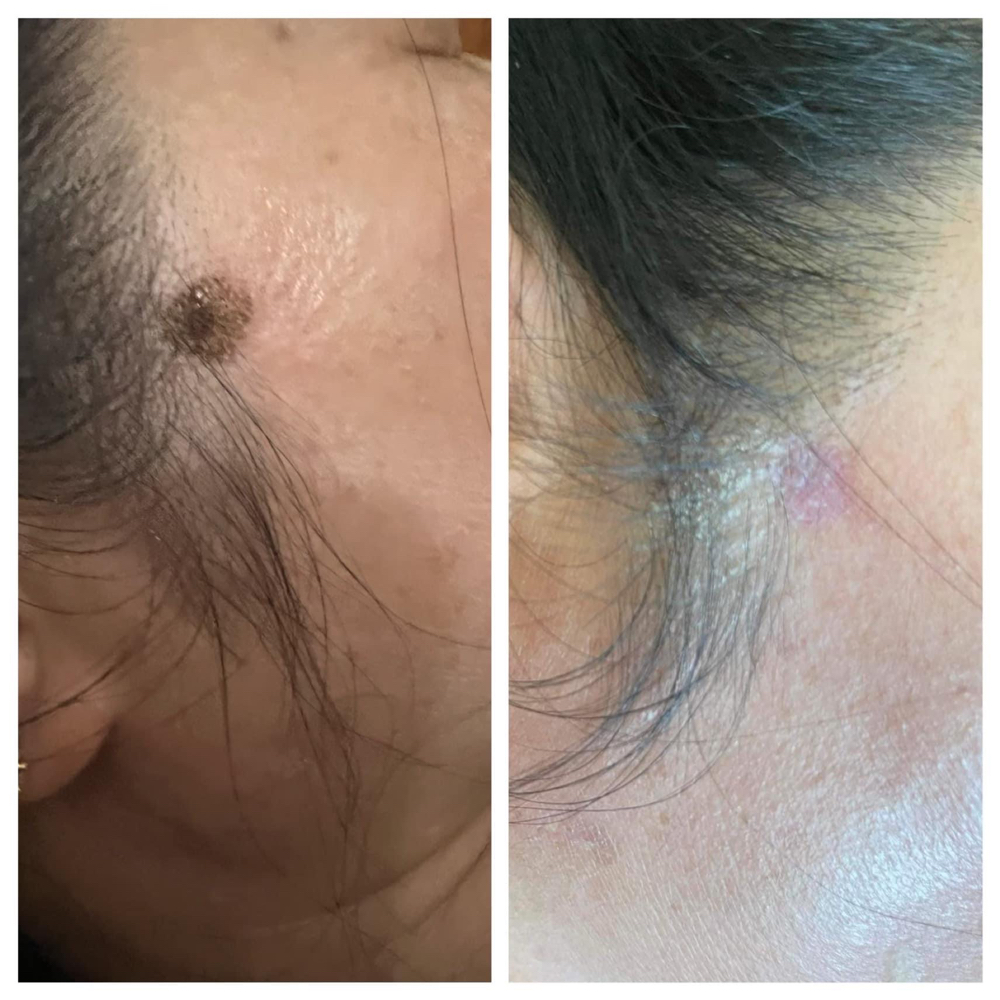 Skin Tag Removal (Each) Dm W/ ?’s