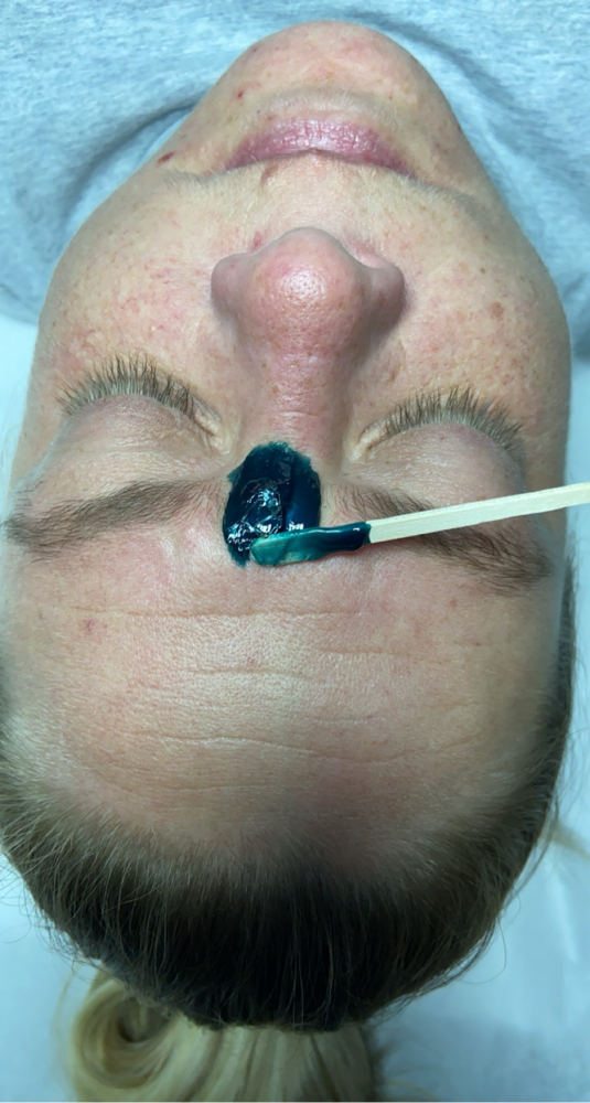 Eyebrow Hair Removal
