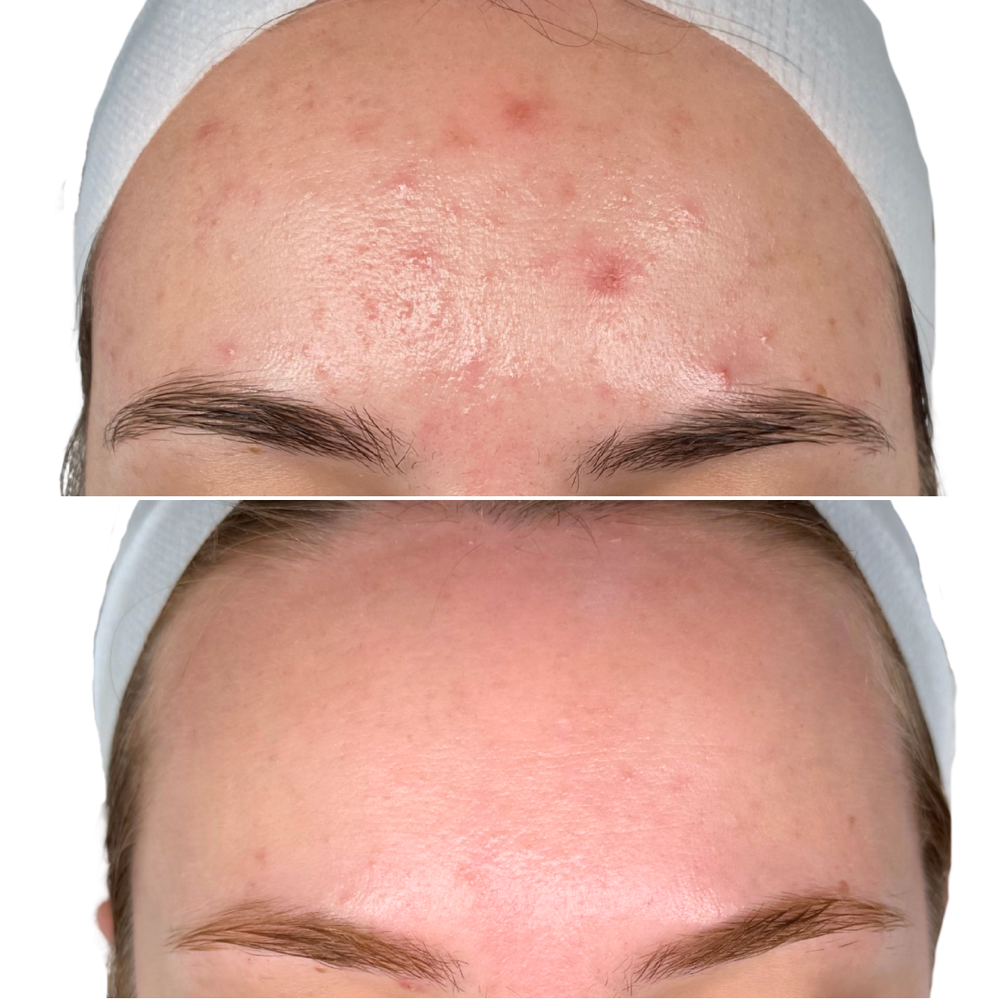 Clear Complexion Facial