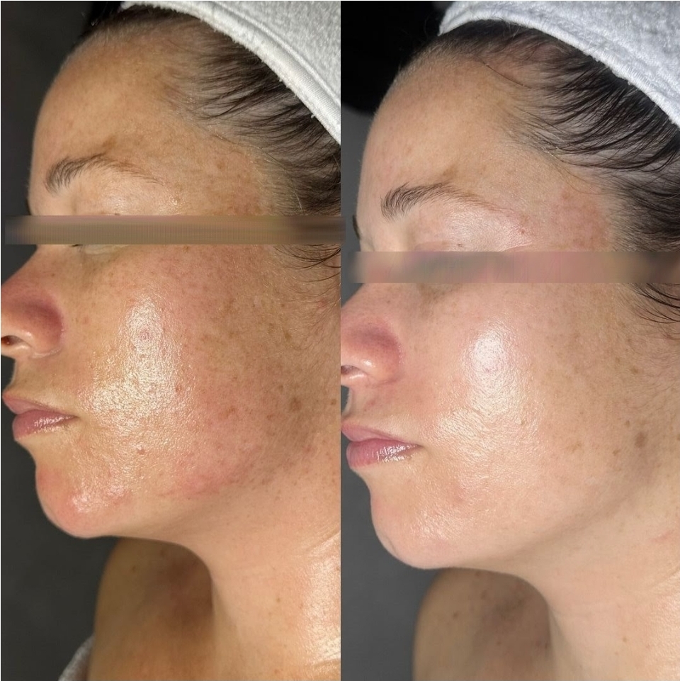 GS Depigmentation Treatment