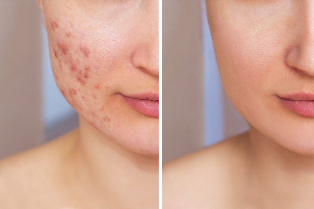 Acne Plan/ Plan Control De Acne