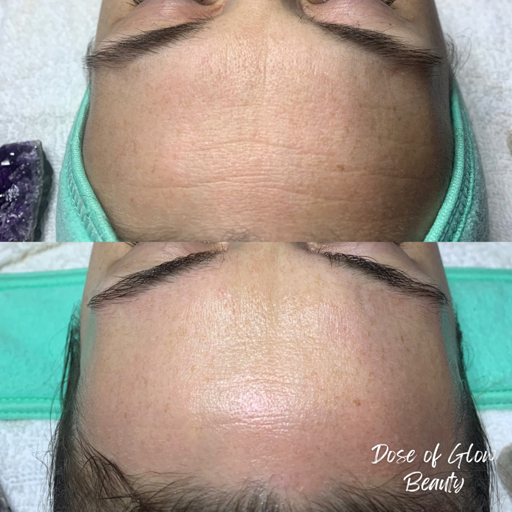 Signature Skin Reset at Dose of Glow in Phoenix, AZ