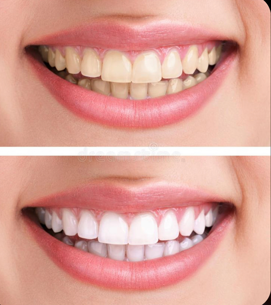 Two Teeth whitening Sessions