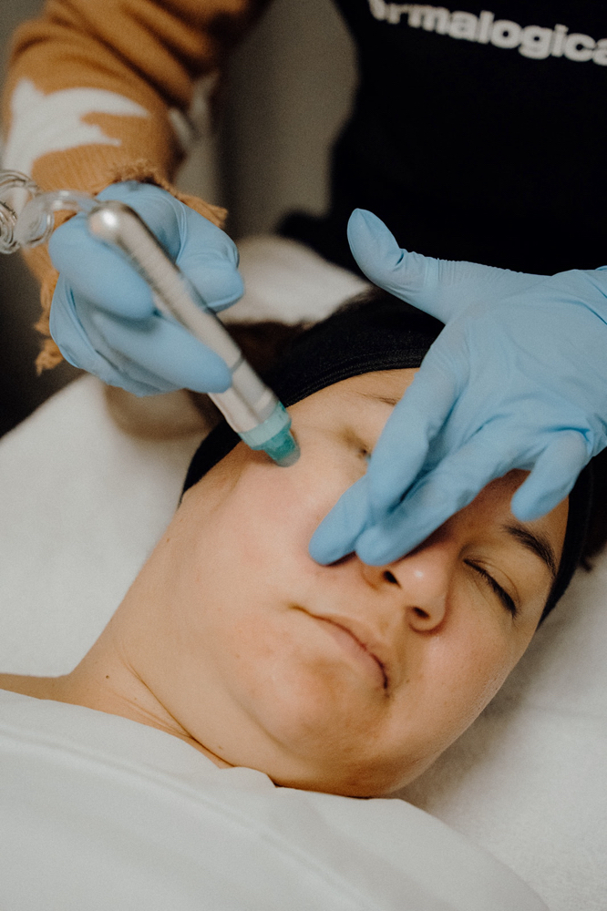 Hydrodermabrasion Facial