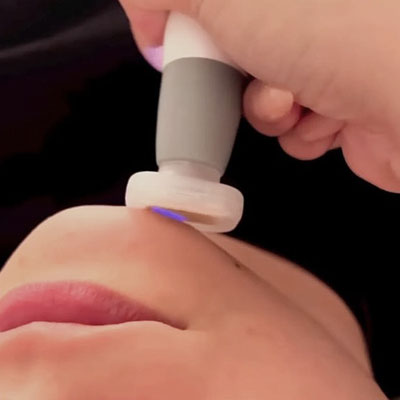 19-JET PLASMA /BIOREPEEL Face& Neck