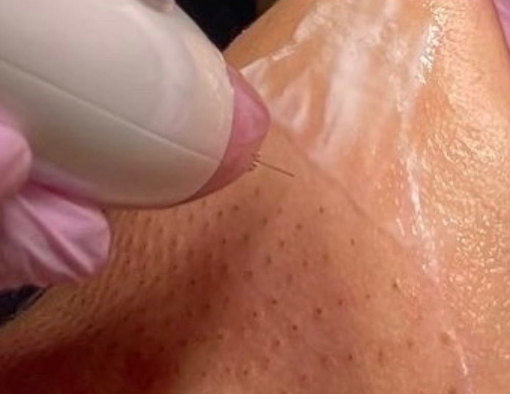 FP PEN-Chin Lift at Skin & Soul Skincare LLC in Tucson AZ, AZ
