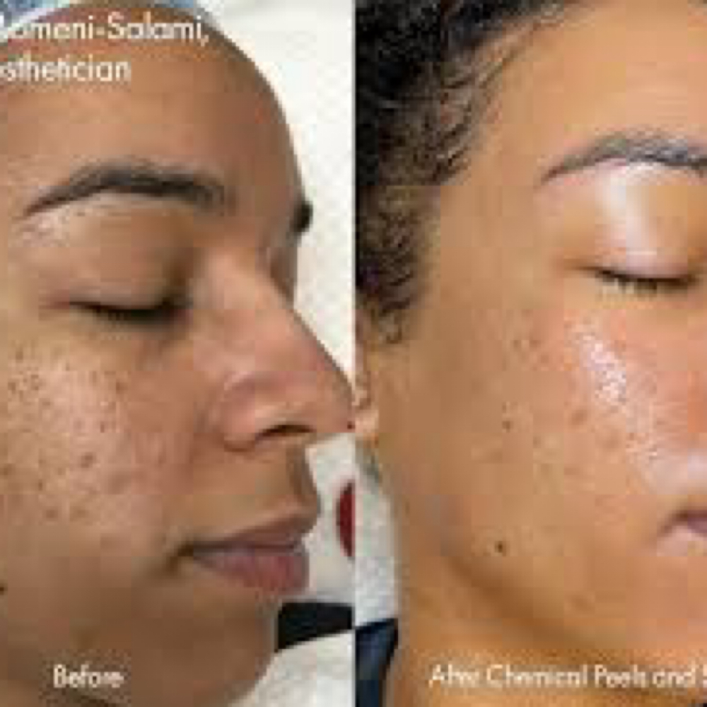 Microneedling at Rejuva Glow Beauty in Bethesda, MD