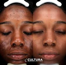 Microneedling