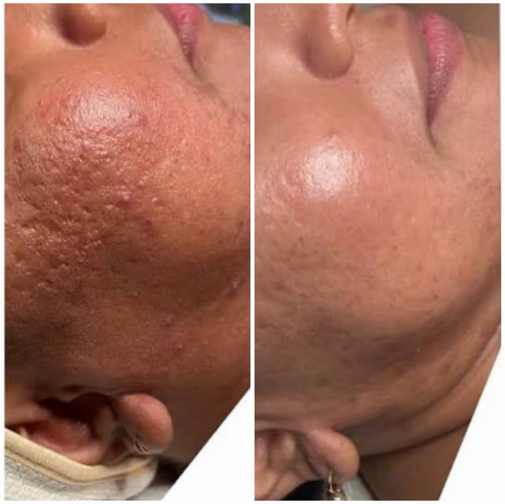 Microneedling at Rejuva Glow Beauty in Bethesda, MD