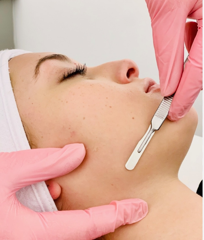 DERMAPLANING WITH PEEL