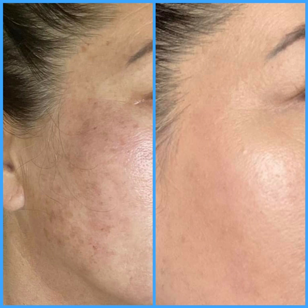 BioRePeel Blue (Face)