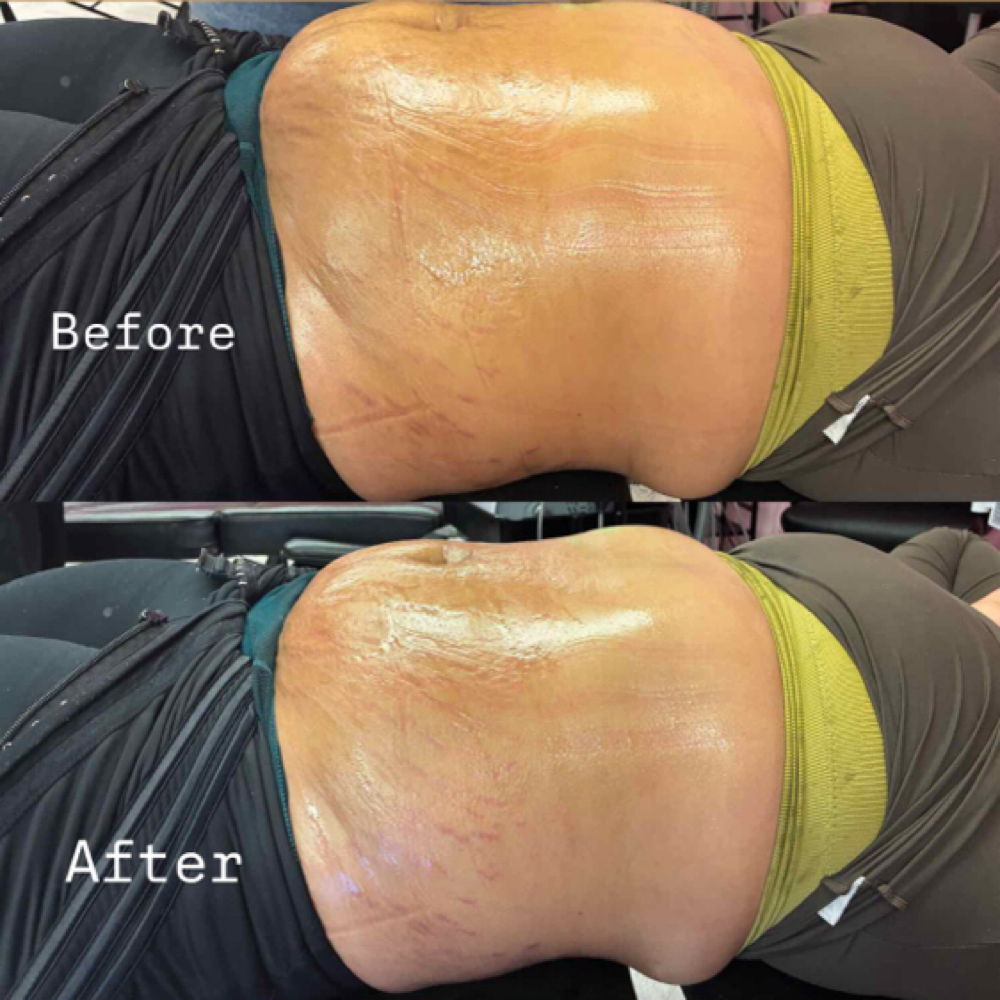 RF Stomach at Infiniteglowspa in Mesquite, TX