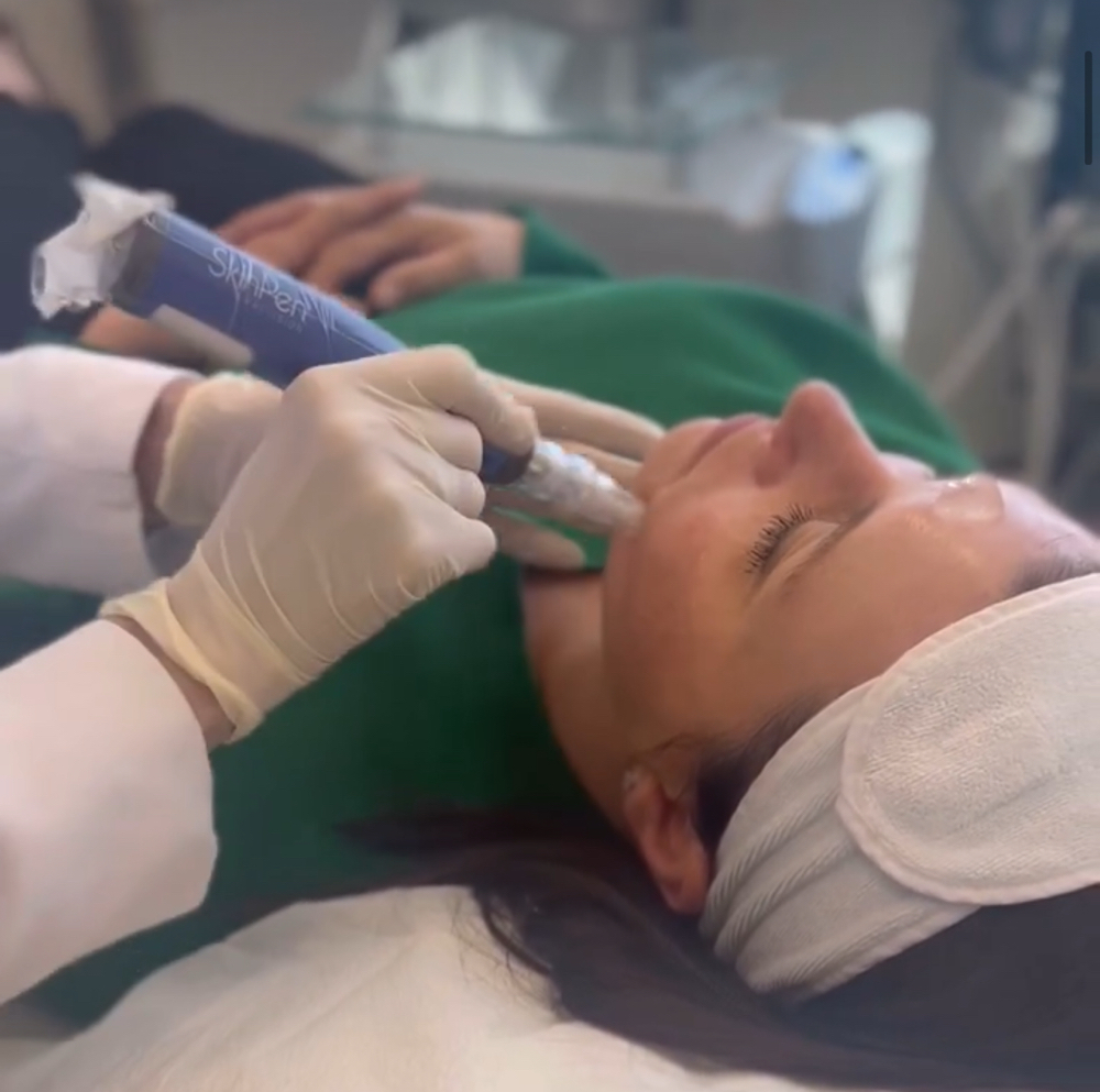 Microneedling- Skin Pen