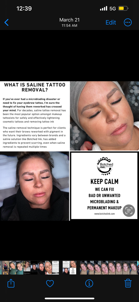 Botched Ink Removal Consultation