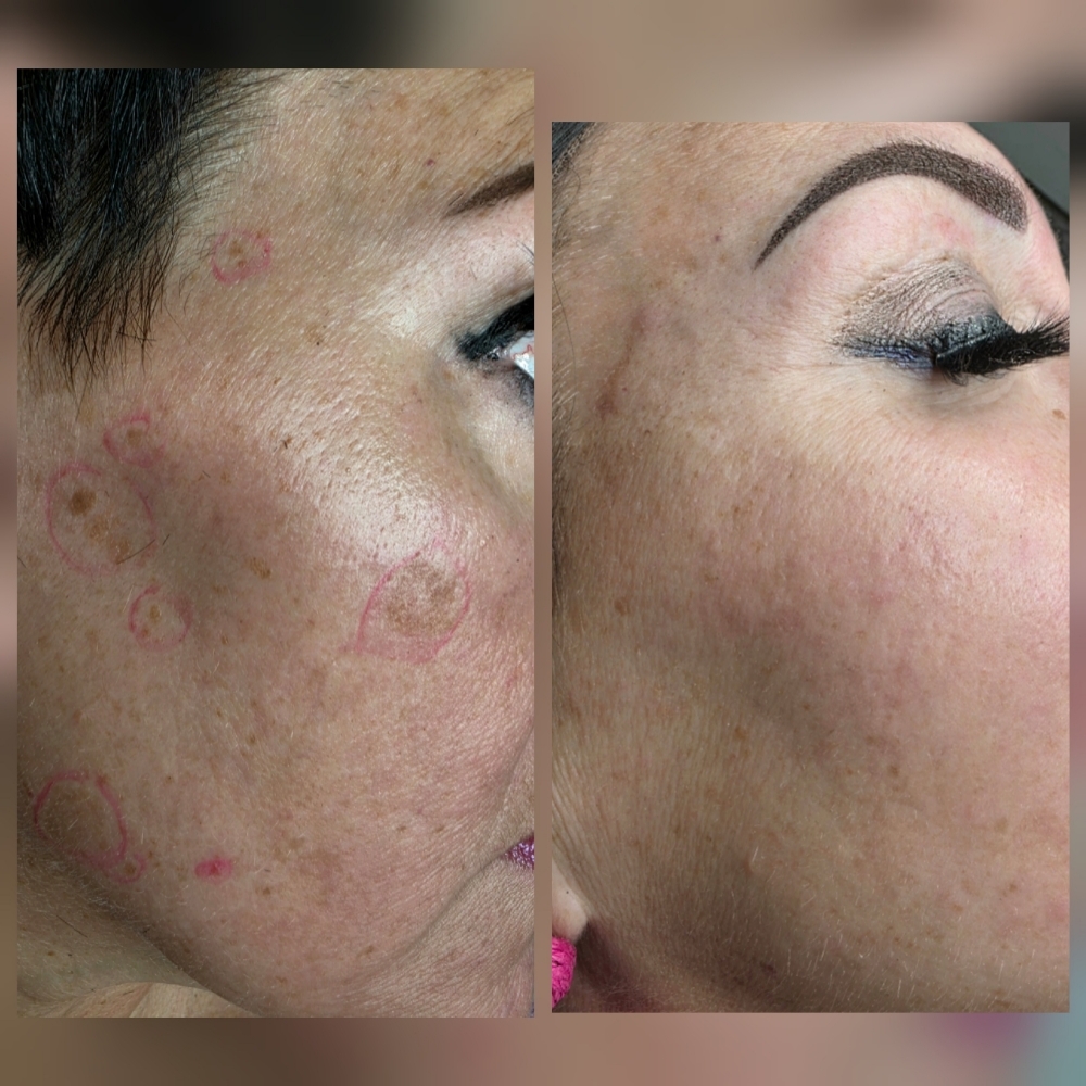 Dark Spot - Aging Spot Removal at Glow Brows & Beyond in Hershey, PA